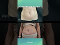 Abdominoplastika | Dermolife