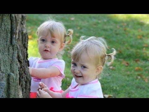 Conjoined Twins Learn to Live Apart