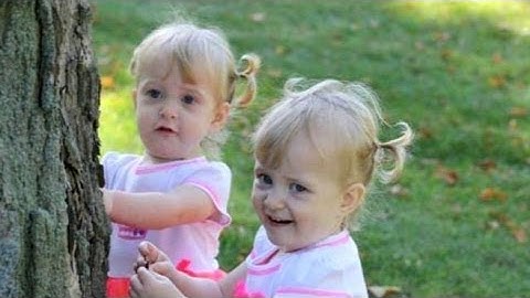 Conjoined Twins Learn to Live Apart