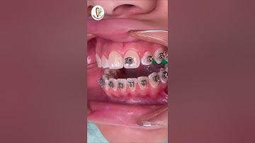 Quy Trình Gắn Mắc Cài Niềng Răng | Short Dental