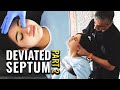 Years of difficulty breathing alleviated! Deviated Septum Adjustment Part 2