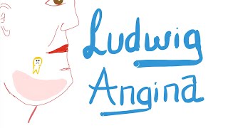 Ludwig Angina | 🚑 | Causes, Clinical Picture, Diagnosis and Management screenshot 5