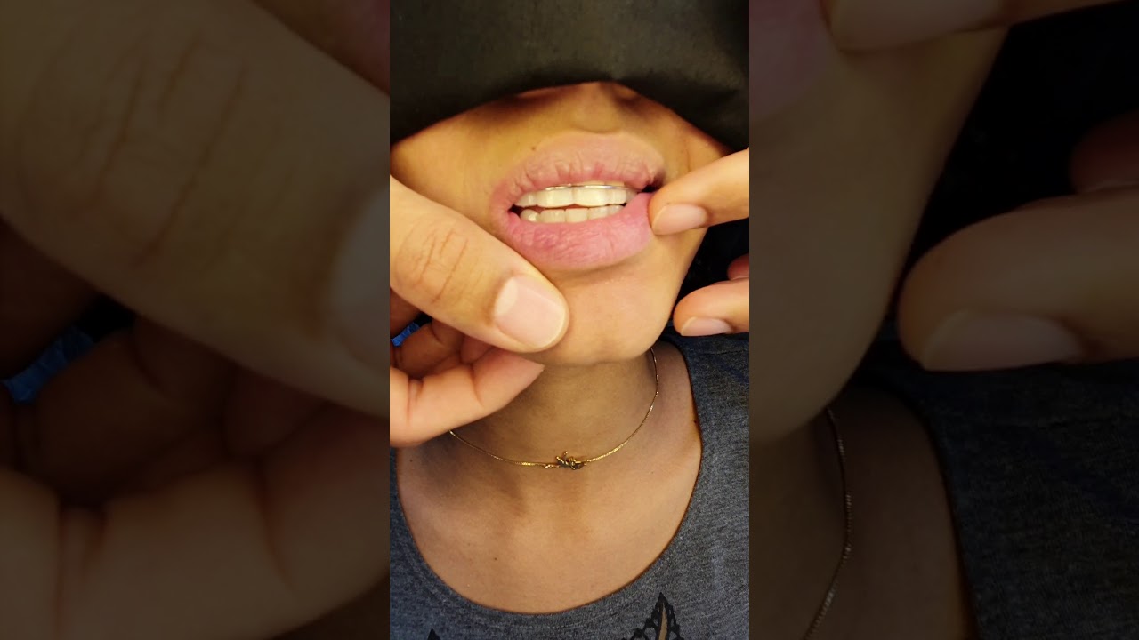 Caso tratado com 2 extrações de dentes superiores, 1 ano de pós concluído