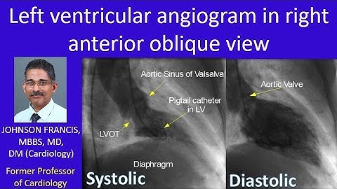 Left ventricular angiogram in right anterior oblique view