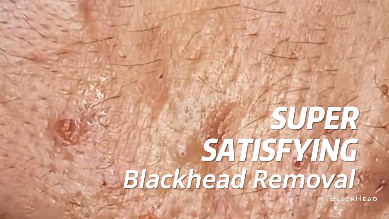 Blackhead Bliss Aesthetic Skin Transformation Fiesta YouTube