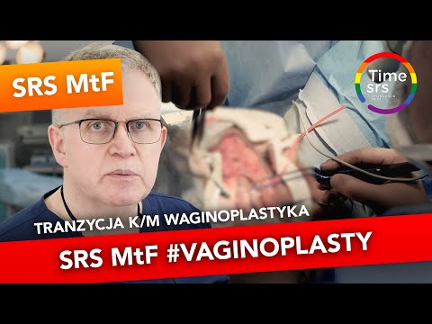 Operacja SRS M/K Waginoplastyka (#SRS MtF #vaginoplasty) - Timeless dr Janusz Jaworowski