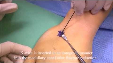 Intramedullary Pinning for Displaced Fifth Metacarpal Neck Fractures: Closed Reduction and...