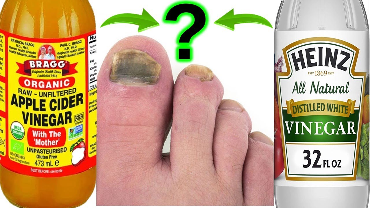 What is Better For Toenail Fungus - White Vinegar or Apple Cider Vinegar ?  - YouTube