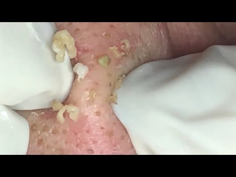 🔥 Pimple Popping 2020 Video| Super blackheads removal in nose| Blackheads extraction| Acne removal