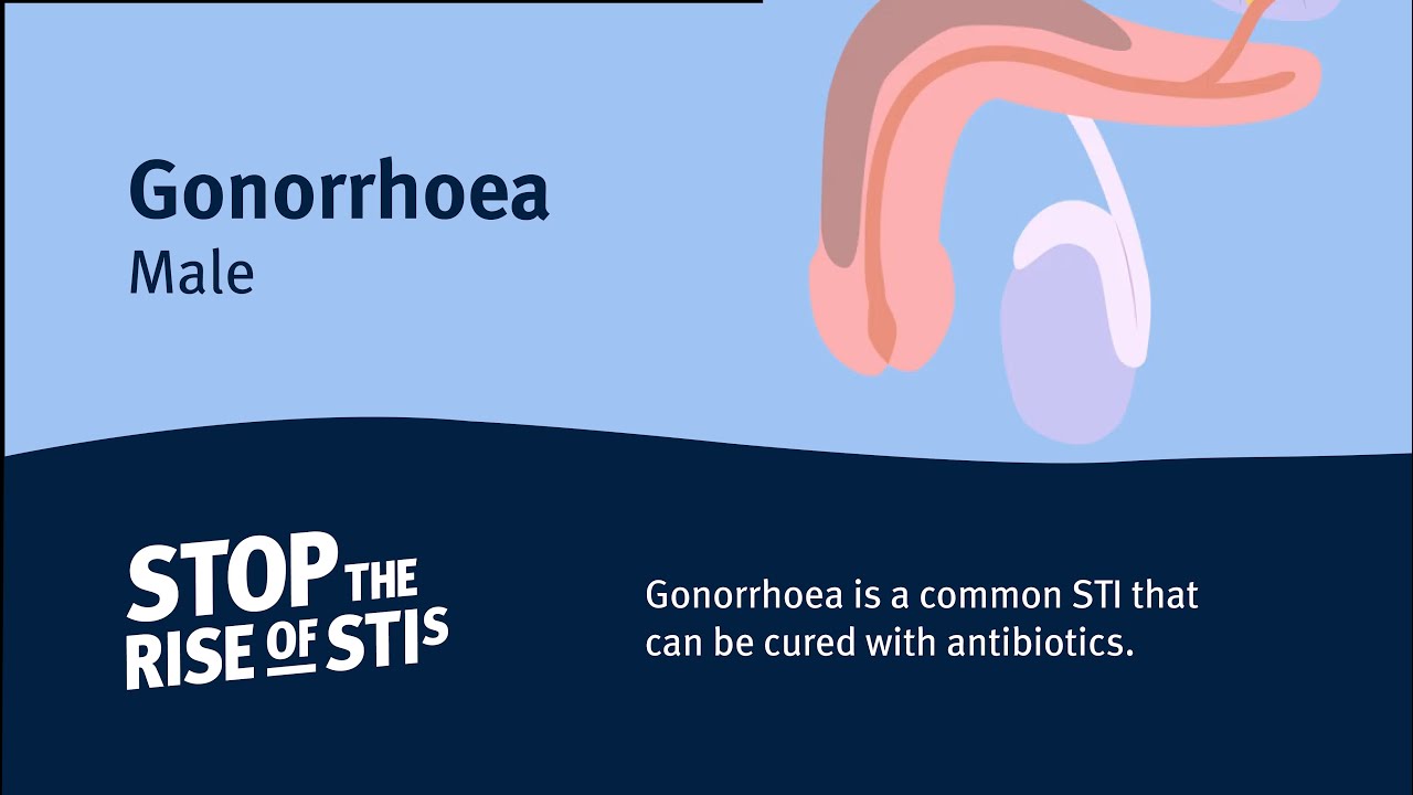 gonorrhoea a péniszen)