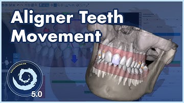 BSP5.0: Faster and More Precise Aligners: BlueSkyPlan