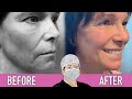 Before & After: Plastic Surgeon Reacts To Own Surgery Results