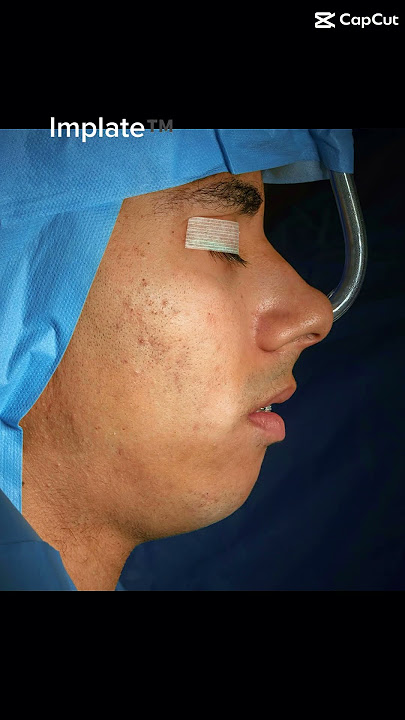 When jaw surgery meets the aesthetic implant for mandible definition #implate #jawsurgery
