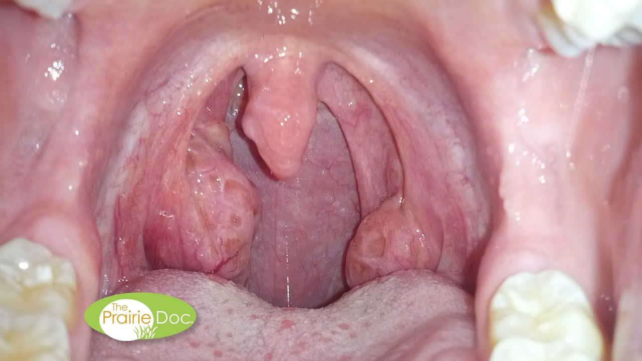 Saved From a Peritonsillar Abscess | By Richard P. Holm, MD