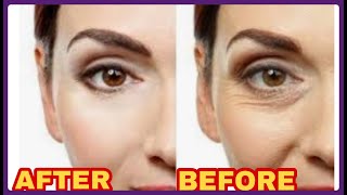 Treating facial wrinkles in three days  علاج تجاعيد الوجه وترهل البشرة في ثلاث ايام