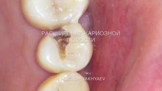 Лечение пульпита зуба 2.5(, 2017-01-09T20:08:24.000Z)