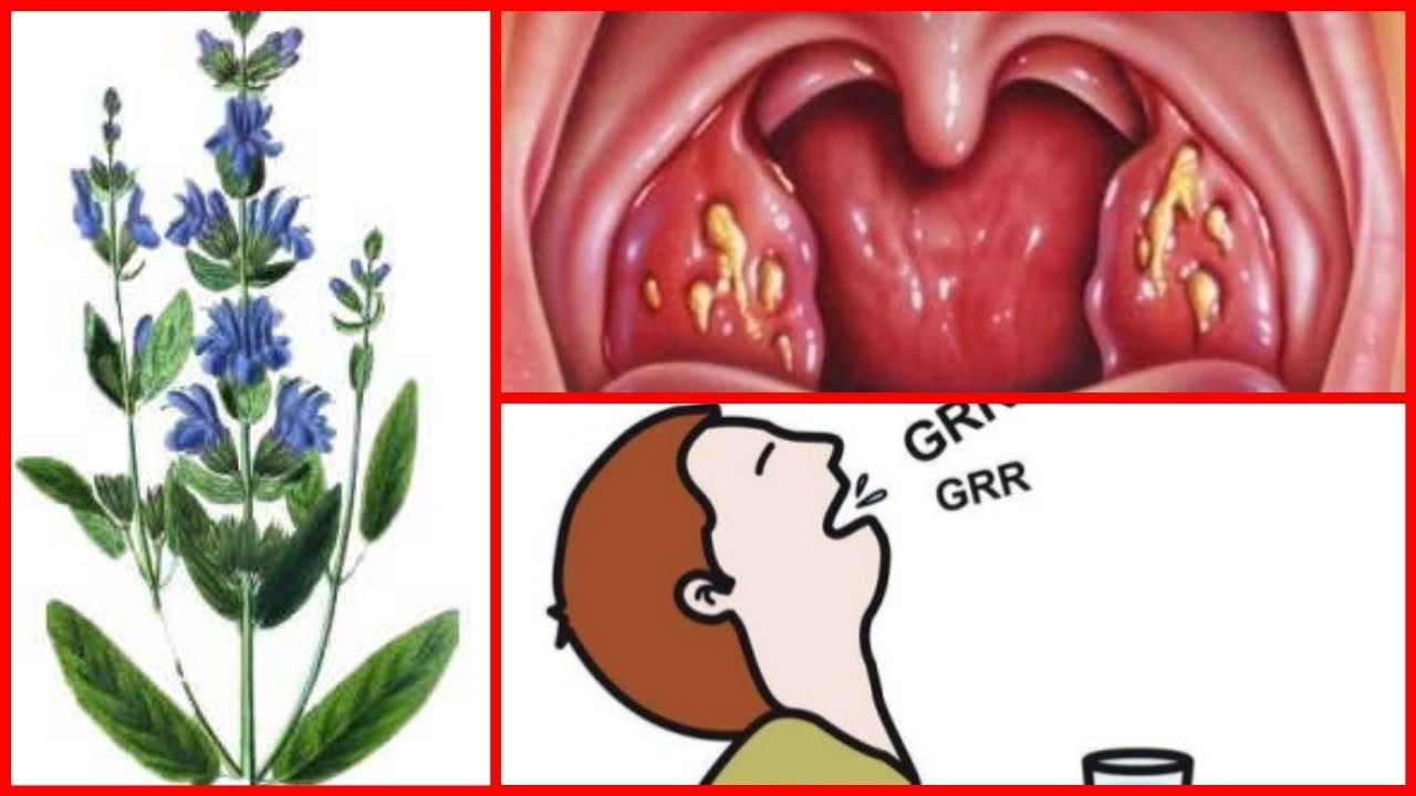 Si eres de las Personas que Sufren de Amigdalitis, Estos Remedios son para ti - Vida Sana remedios naturales para la artritis