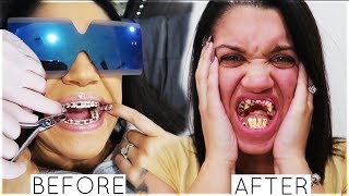 I SHOULD'VE NEVER GOT BRACES 💔...