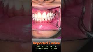 Advanced Immediate Loading Implants | Best Dental Implant Clinic in Hyderabad