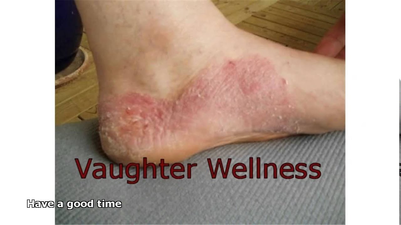Fungal Rash On Foot