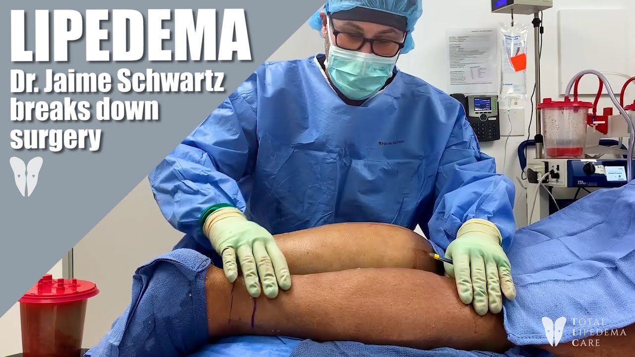 Lipedema Reduction Surgery | Lipedema Treatment Explained by Lipedema