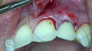 Connective Tissue graft using the VISTA Technique