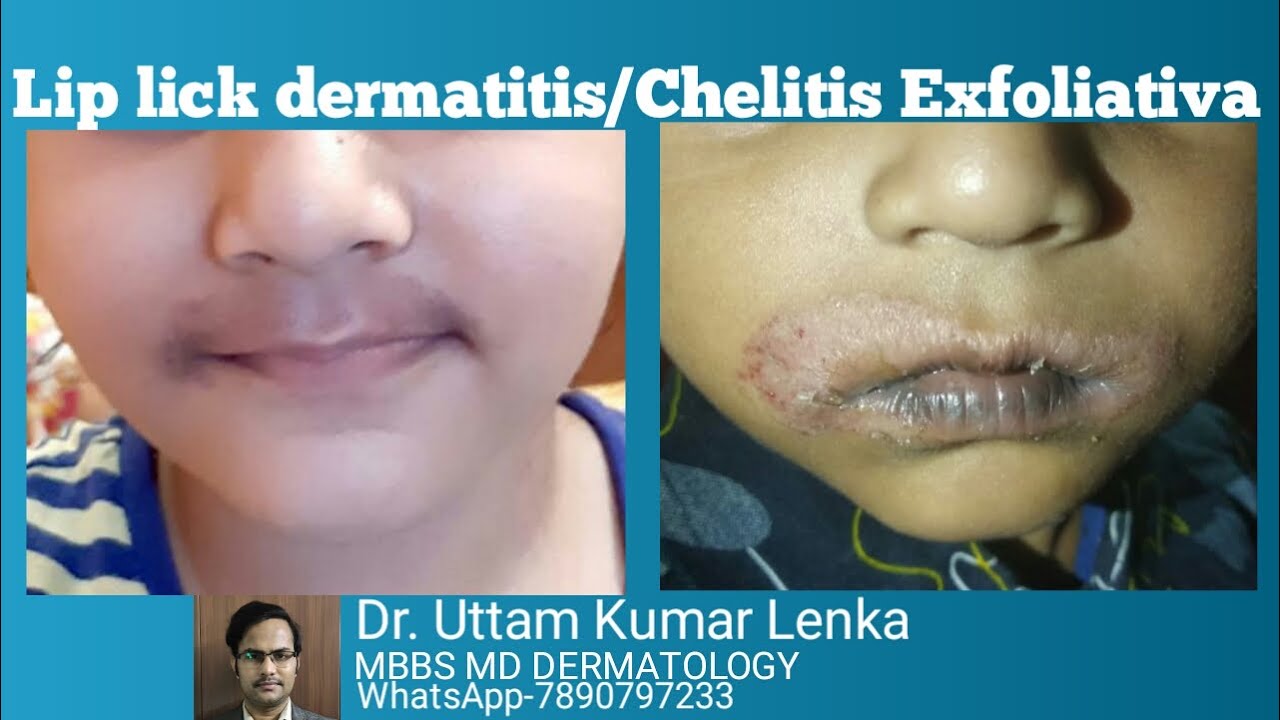 Lip lick chelitis/allergy/rashes/skin peeling around mouth/lips.(Hoth