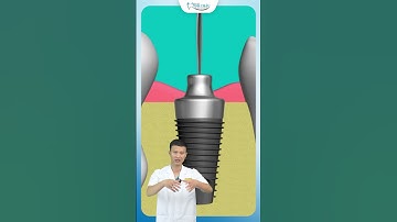 Quy Trình Gắn Trụ Răng Giả | Bác Sĩ Yên