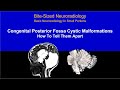 Posterior Fossa Cystic Malformations Made Easy - How To Tell Them Apart