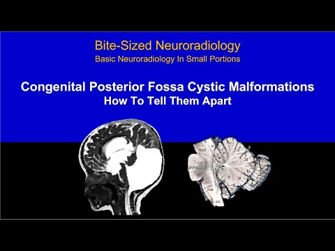Posterior Fossa Cystic