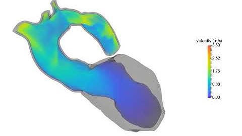 Left ventricle and aorta blood flow simulation in a CoA case