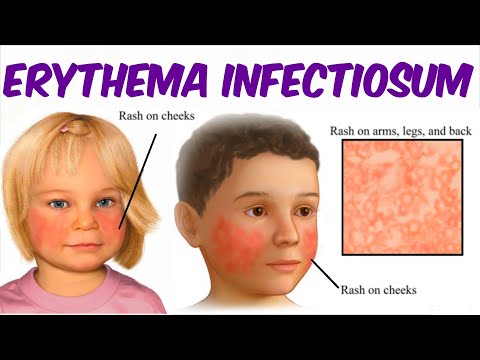 Erythema Infectiosum! (Fifth Disease) 