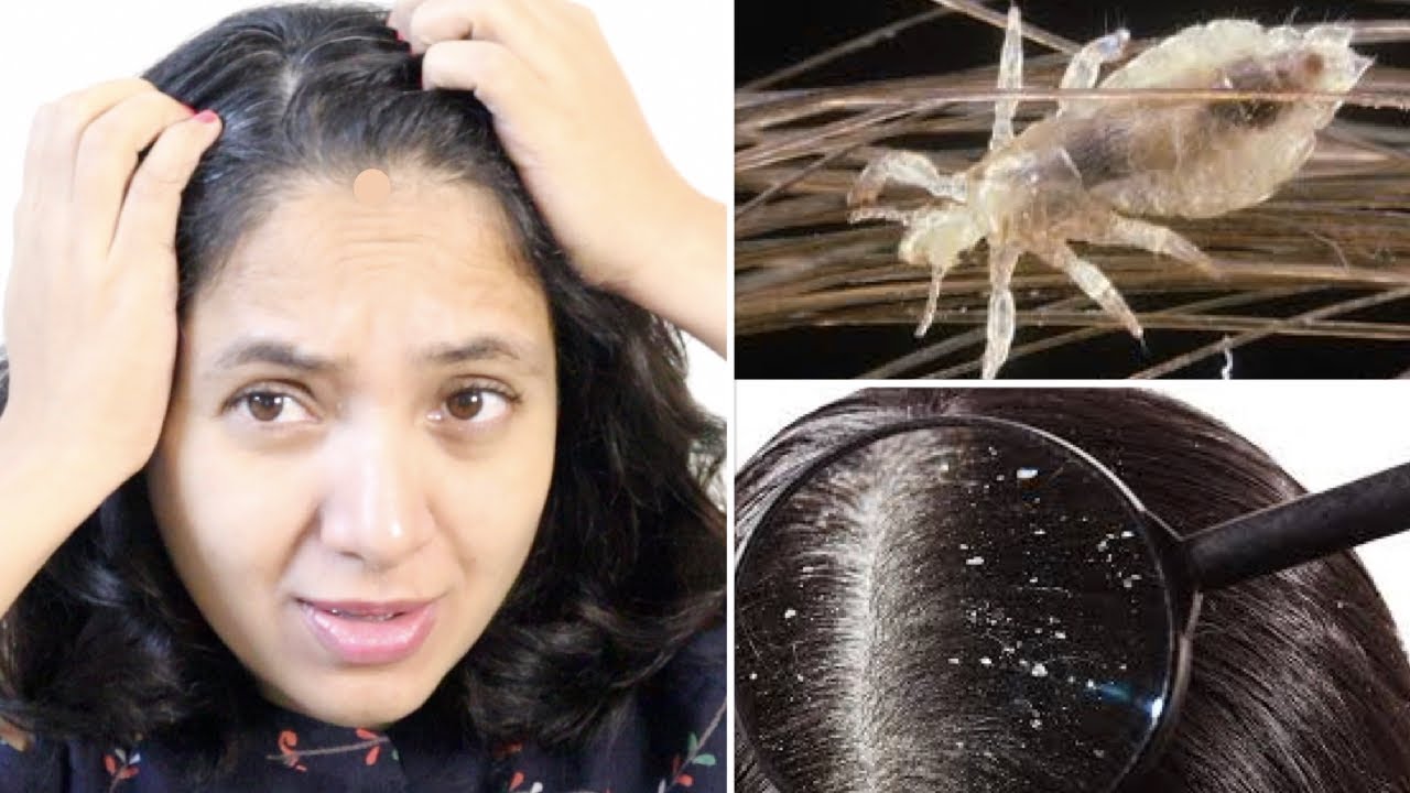 Head lice Causes symptoms and treatments