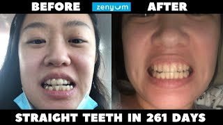 My Zenyum Journey: Straight teeth in 9 months!!