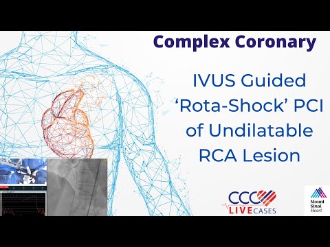 IVUS Guided ‘Rota-Shock’ PCI of Undilatable RCA Lesion