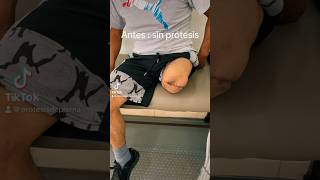 Amputación Y Prótesis