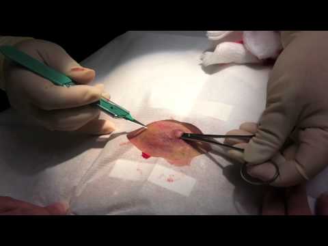 Incision and Loop Drainage - YouTube