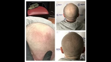 Fill in your HAIRLINE with ScalpMicropigmentation
