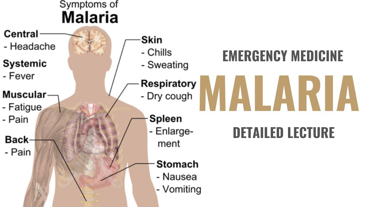Буквы малярия. Клинические проявления малярии.