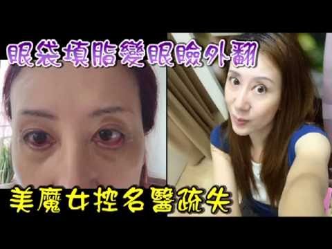 美魔女填眼袋眼瞼竟外翻 蘋果日報 Youtube