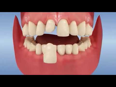 Facettes dentaires
