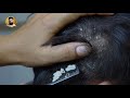 Scratching Dandruff Off Scalp!! Big Flakes Dandruff Removal | Mr Dandruff Flakes #05