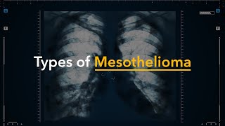 Celebrity Types of Mesothelioma - Understanding Mesothelioma Profile