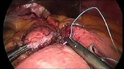 Gastric Bypass Surgery Demonstration: Memorial Weight-Loss Surgery Program