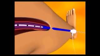 Varicose Vein Laser Treatment