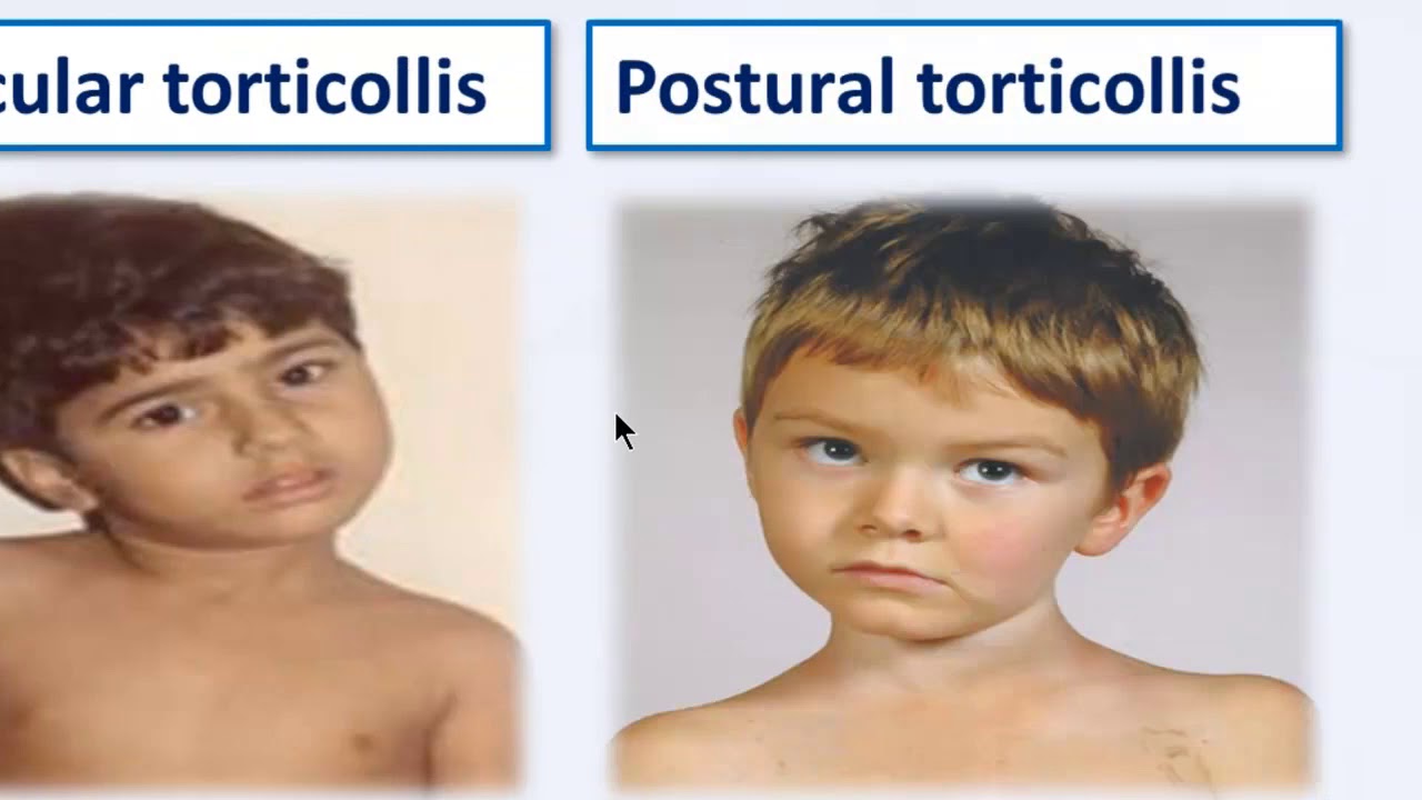 Pt 03 Congenital Muscular Torticollis Types Youtube