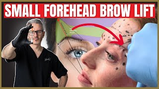 How To Perform a Botox Brow lift on a small forehead.