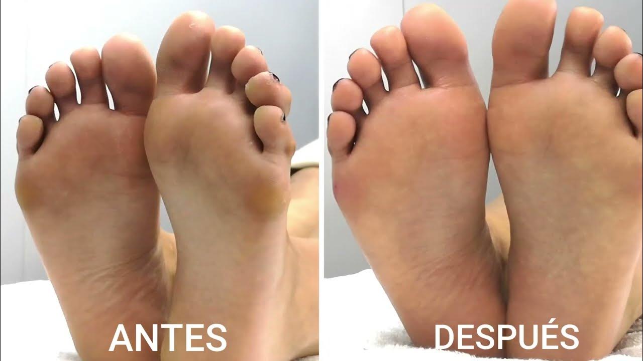 Como curar uña encarnada y quitar los callos de los pies - Centro Médico El  Pilar