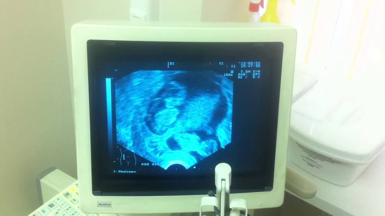 Узи двойни, 10-11 недель | Twins Ultrasound (10-11 weeks)