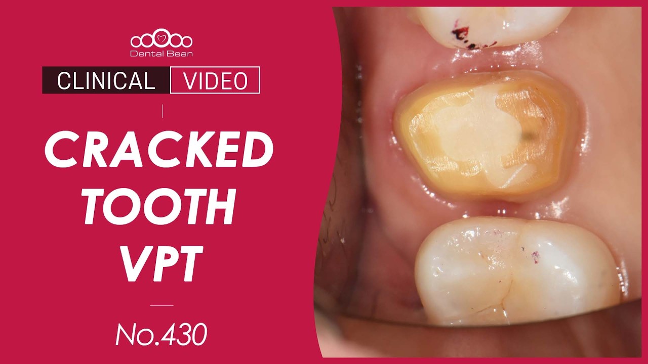 Vital pulp therapy (VPT) of #16 cracked tooth [Dr. Park Charyum] - YouTube